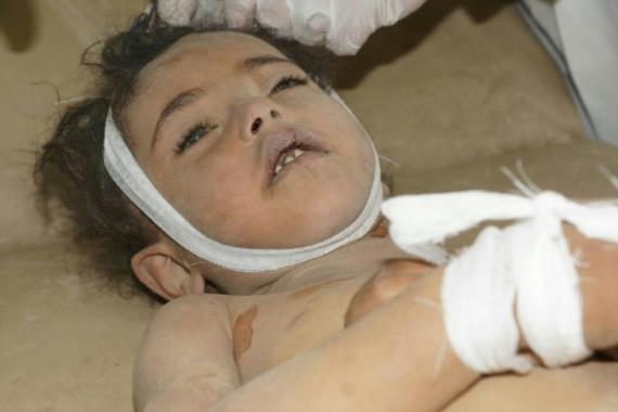 اسماء+صور : استشهاد طفلين وإصابة رجل وثلاثة أطفال بجريمة جديدة لطيران العدوان بصعدة