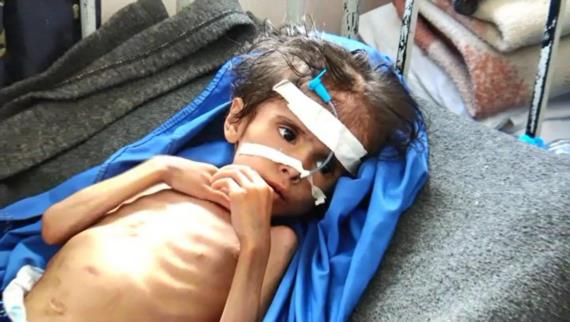 أطفال صعدة .. معاناة يفاقمها استمرار العدوان والحصار