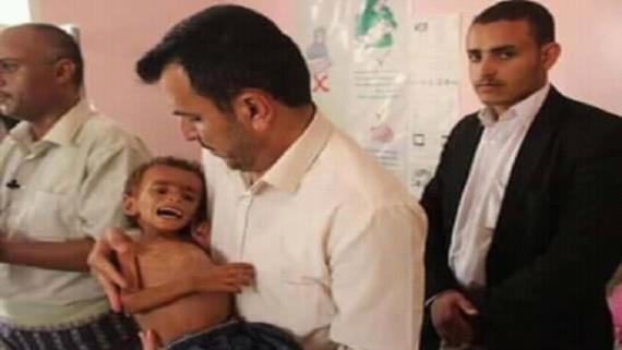 وزارة الصحة اليمنية تدق ناقوس الخطر.. وتدعو أحرار العالم إلى التحرك الجاد لرفع الحصار