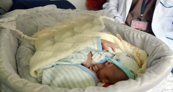التوأم السيامي يغادر مطار صنعاء على متن طائرة إخلاء طبي